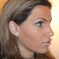 How Often Do Rhinoplasties Go Wrong?