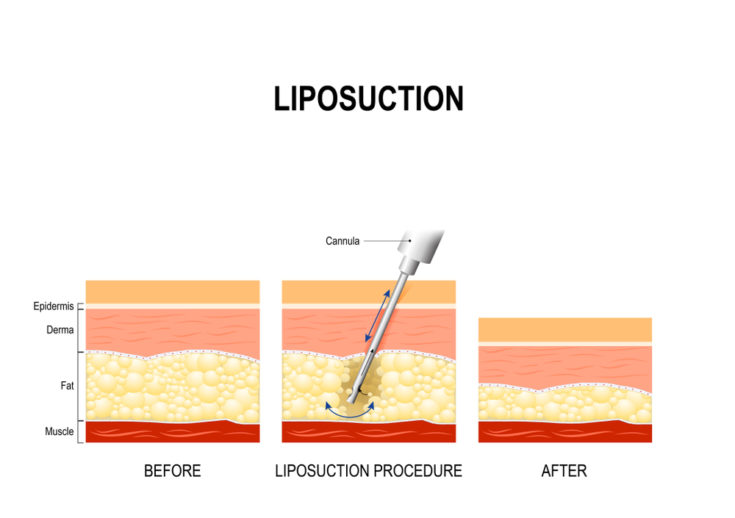 liposuction procedure