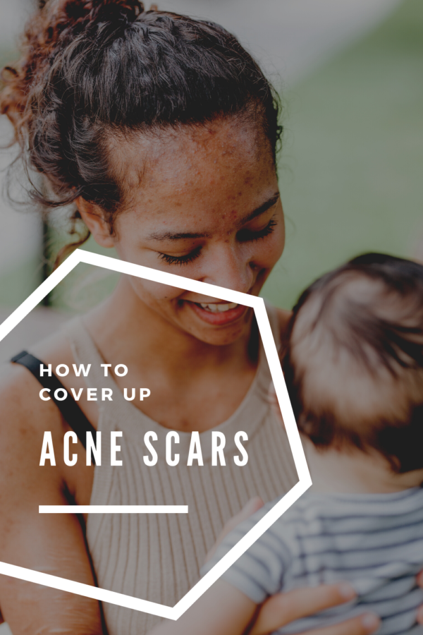Cover Up Those Bad Acne Scars