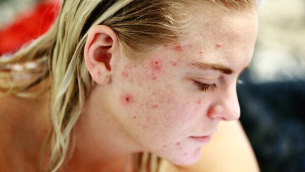 struggle with acne