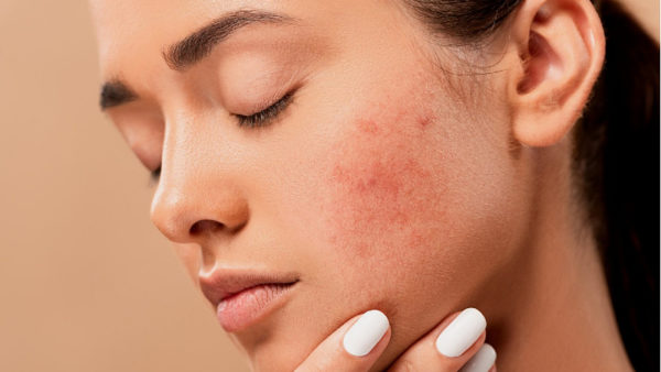 Solutions for Acne
